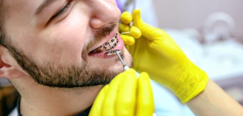 mężczyzna na wizycie i regulacji aparatu na zęby u ortodonty